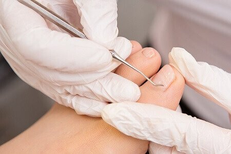 Tratamiento de Uñas Medicadas - PodoSalud