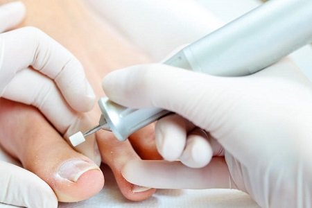 uñeros - podosalud - 2